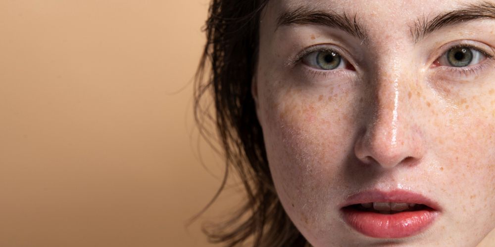 Melasma vs. Hyperpigmentation: Key Differences You Must Know